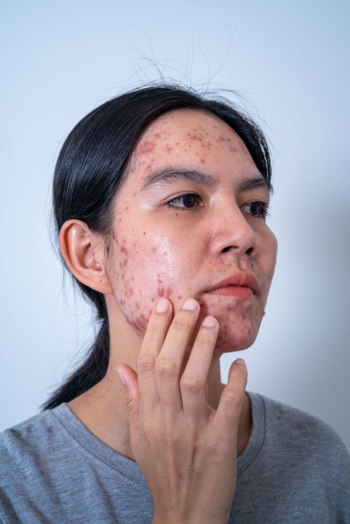 Acne Management