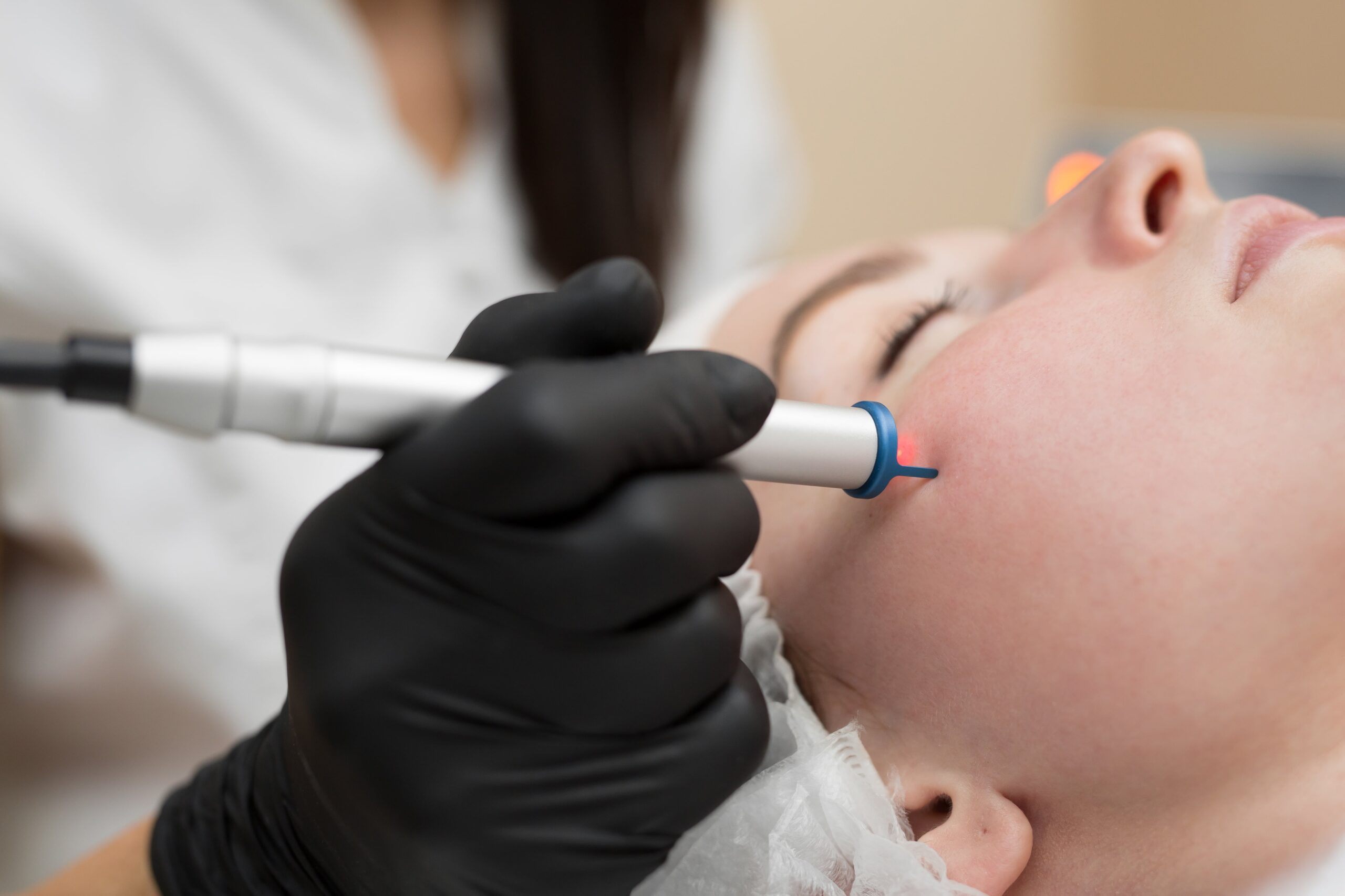 Acne scar laser treatment MNRF in Bhavnagar