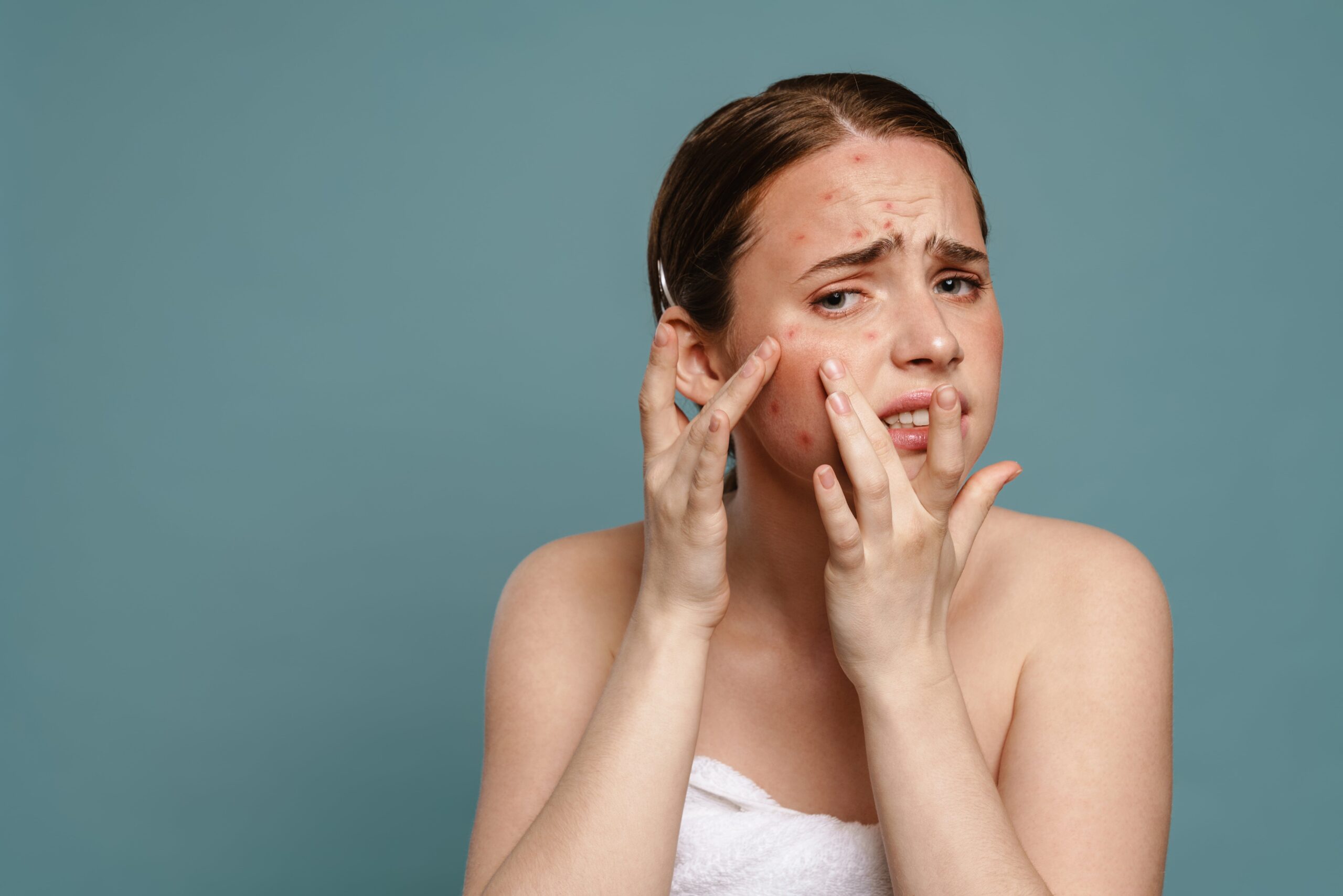 Acne management treatment by best dermatologist in Bhavnagar