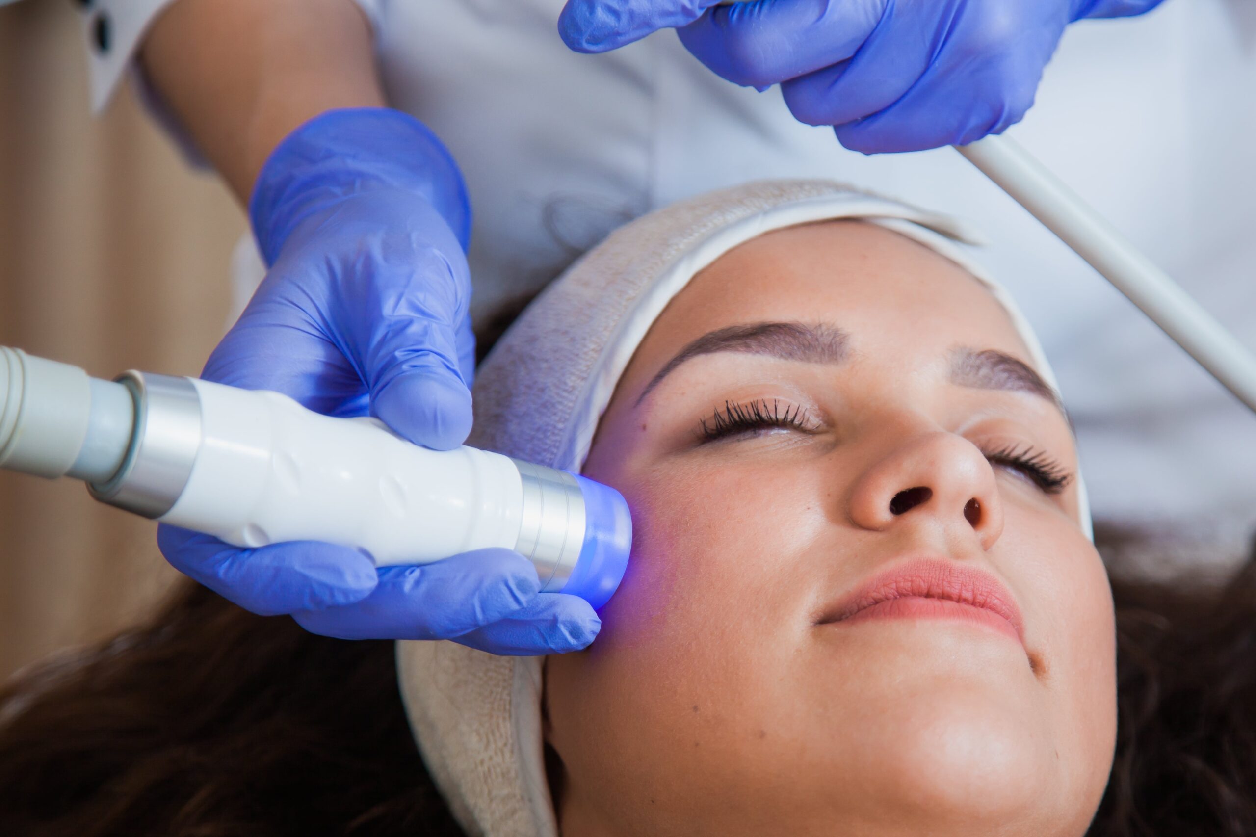 MNRF laser for acne scar removal at Nirmal Skincare