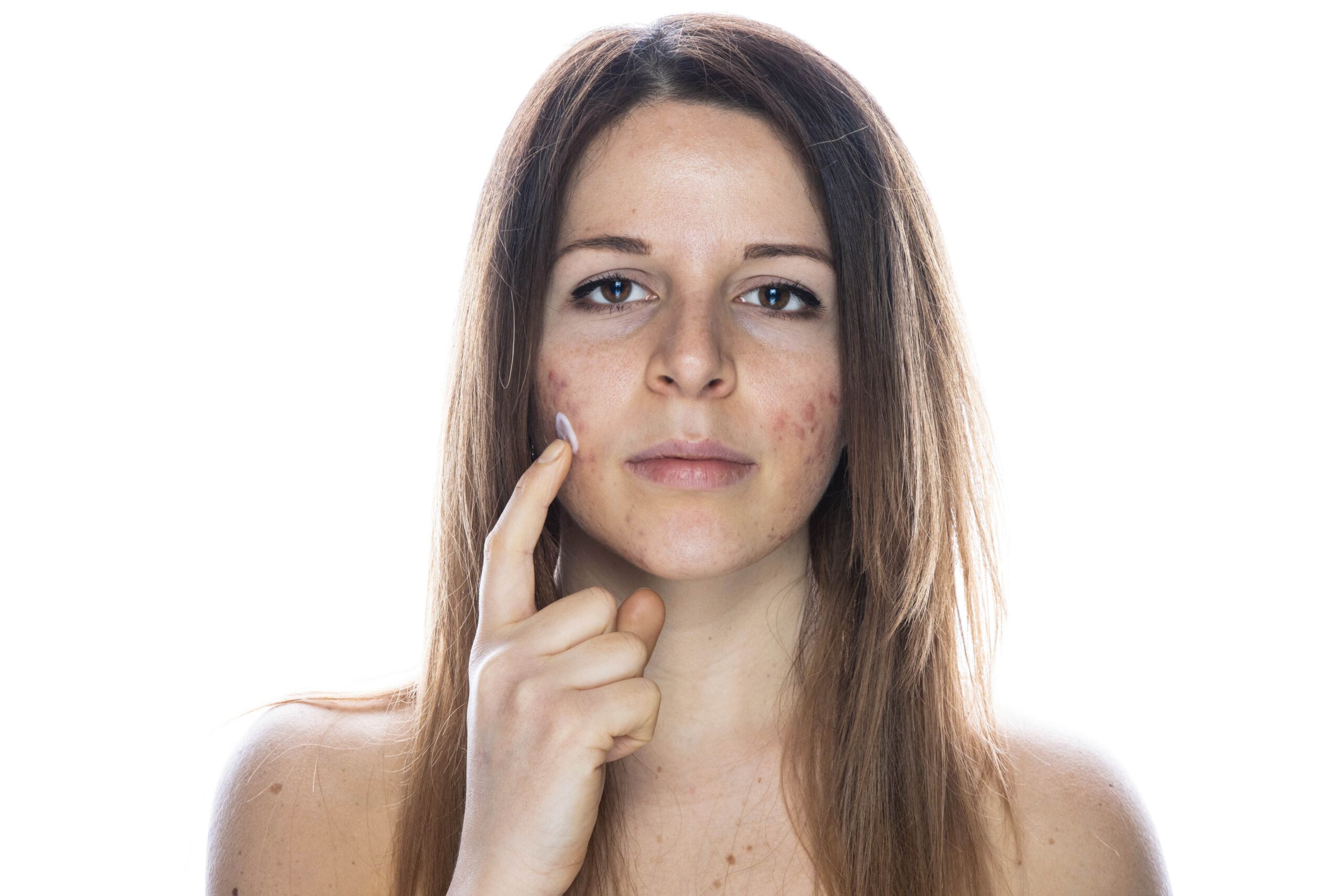 Clear skin results from acne management at Nirmal Skin Care Clinic