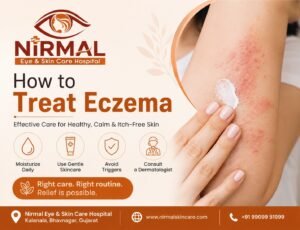 how to treat eczema